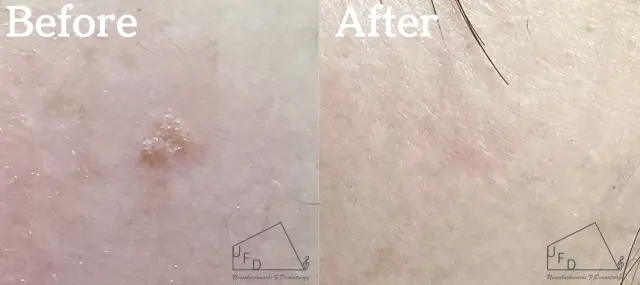 症例1 【30歳代女性】右頬の老人性イボ(脂漏性角化症)