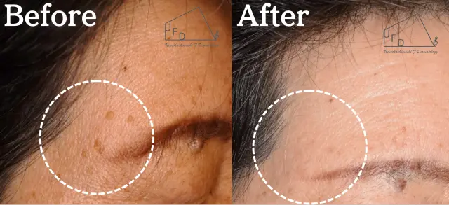 症例2 【50歳代女性】額の老人性イボ(脂漏性角化症)