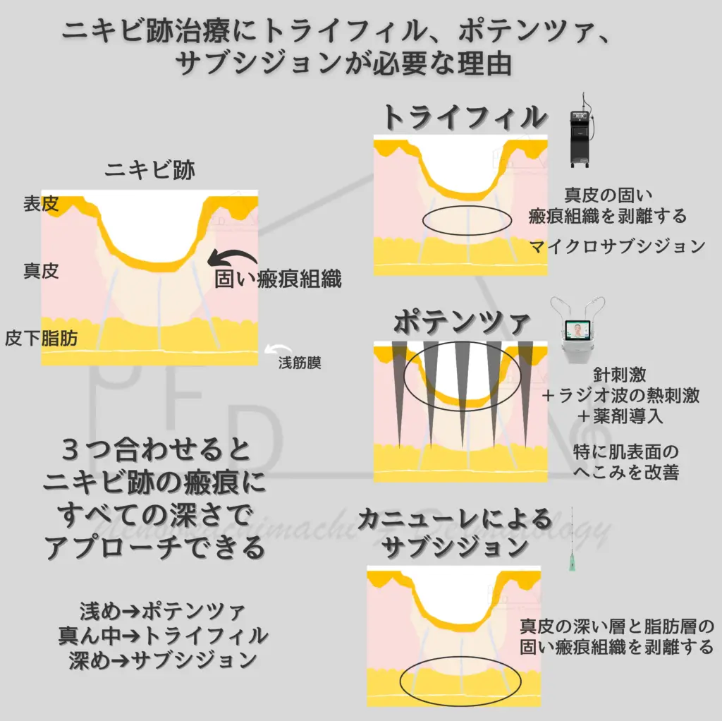 ニキビ跡に対するファラドメソッド