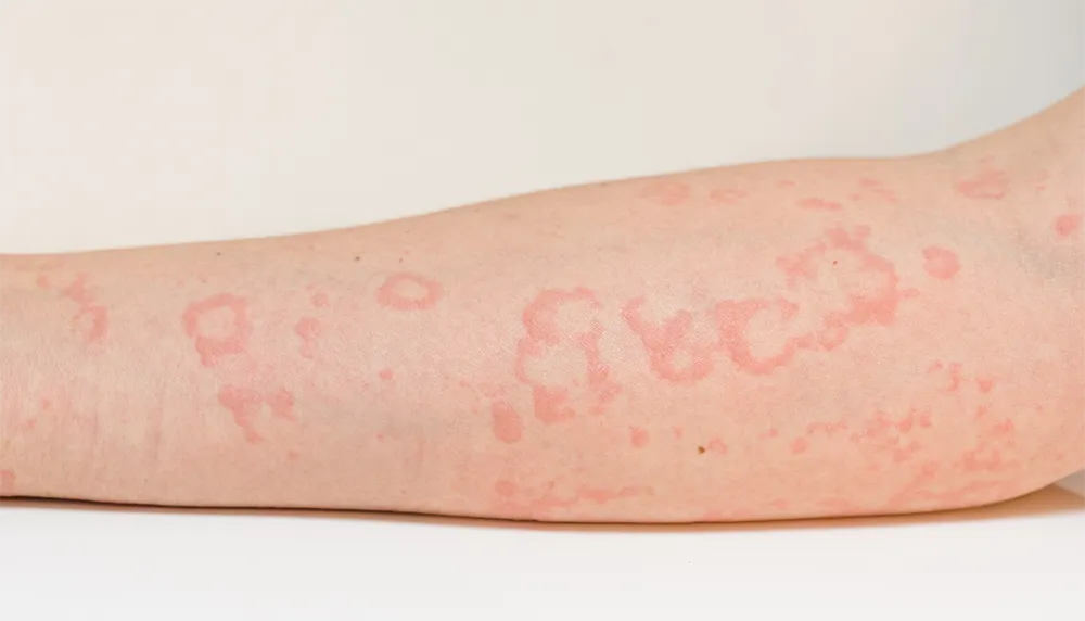 じんましんの画像