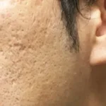 サブシジョン