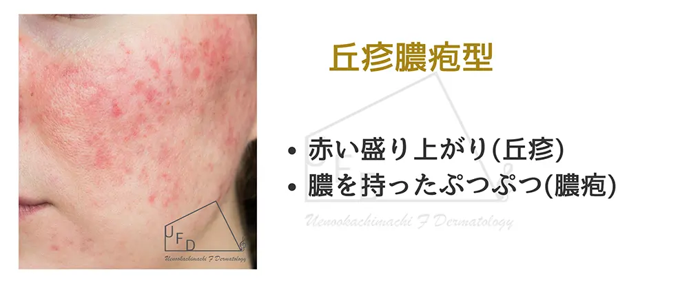 丘疹・膿疱(きゅうしん・のうほう)型(第II度 酒さ性痤瘡)