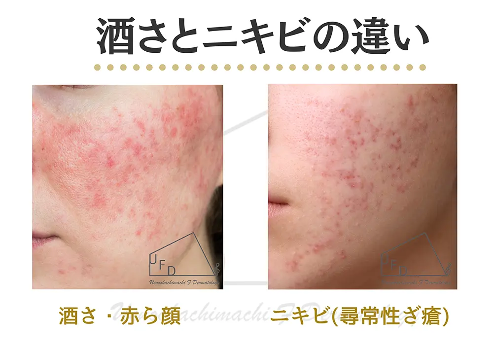 酒さ(赤ら顔)とニキビ(尋常性ざ瘡)との違い