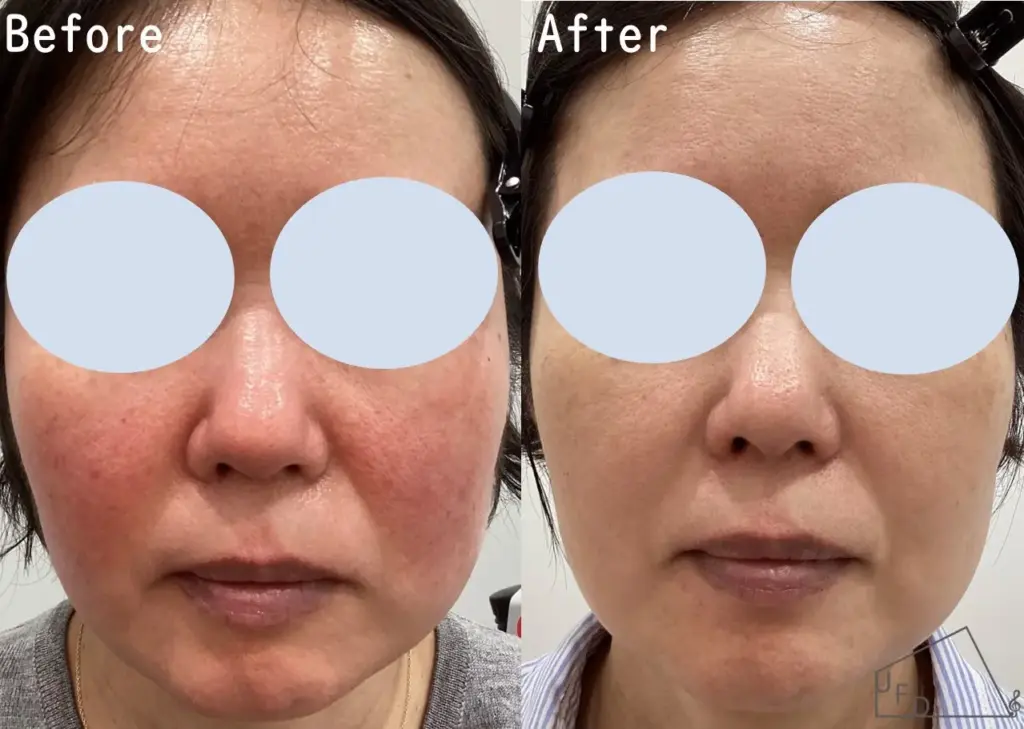 症例1 【40歳代女性】酒さ・赤ら顔