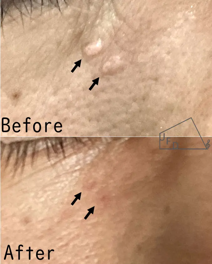 症例2【40歳代女性】右頬の脂腺増殖症