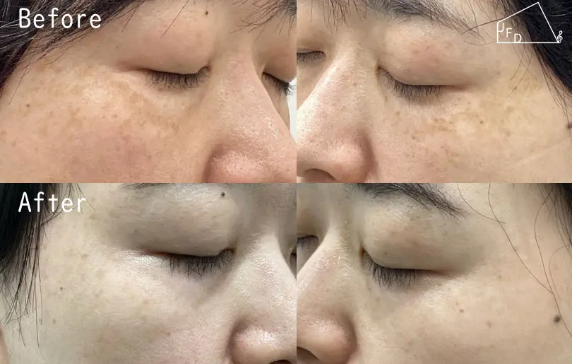 症例 【40歳代女性】両頬の肝斑、老人性色素斑