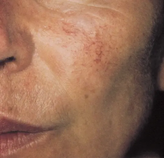 毛細血管拡張症とは