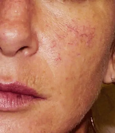 毛細血管拡張症の原因