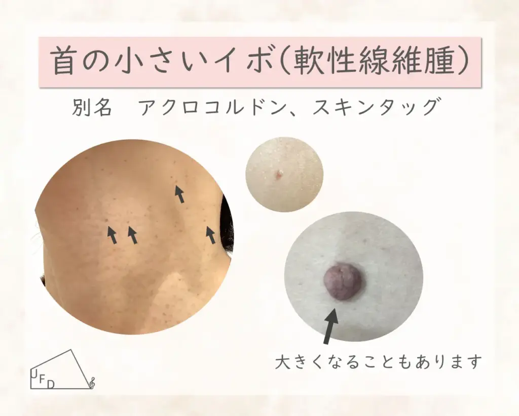 首イボについて