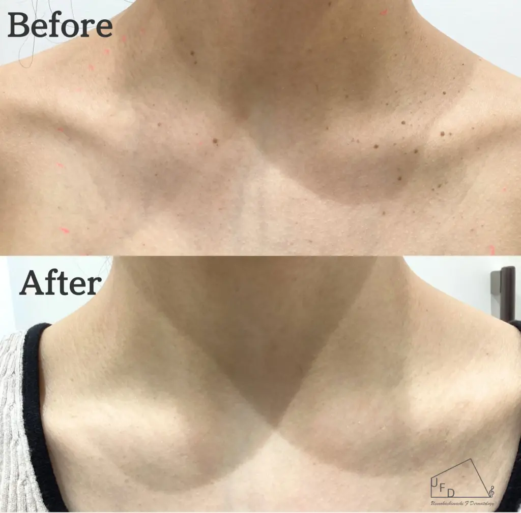 症例 1【30歳代女性】首のイボ