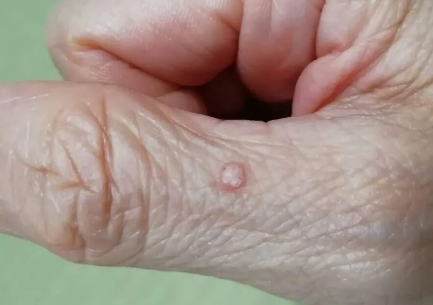 ウイルス性イボについて