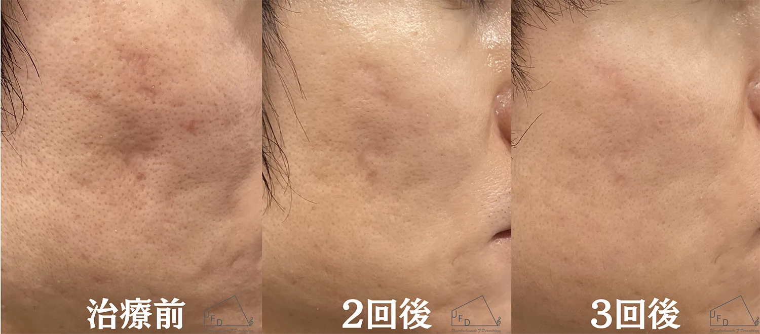 症例1 【30代男性】頬のニキビ跡(サブシジョン3回施行実施)
