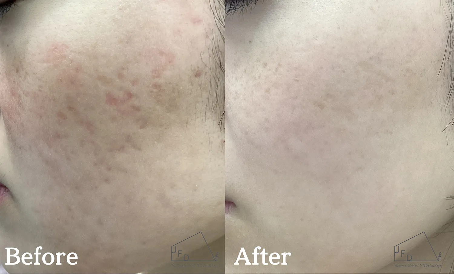 症例2 【20歳代女性】頬のニキビ跡(サブシジョン3回実施)