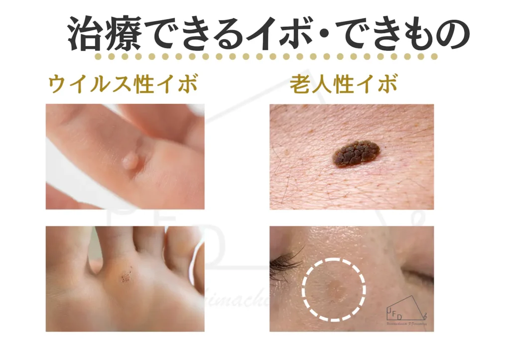 期待窒素療法で治療できるイボ できものの種類