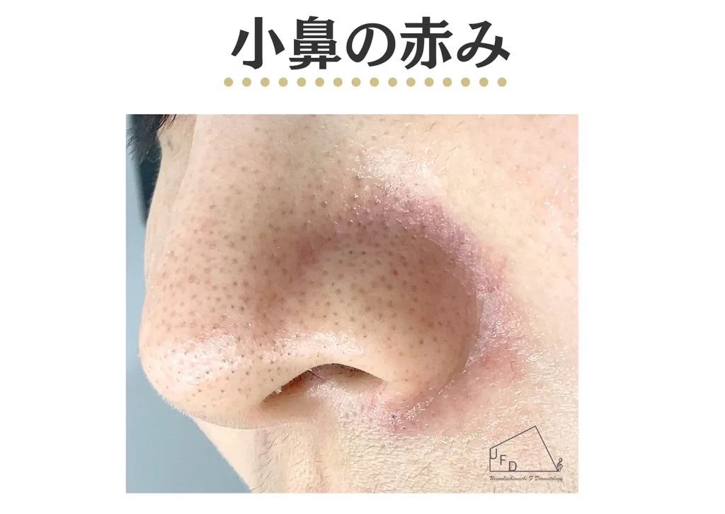 小鼻の赤みの症状写真