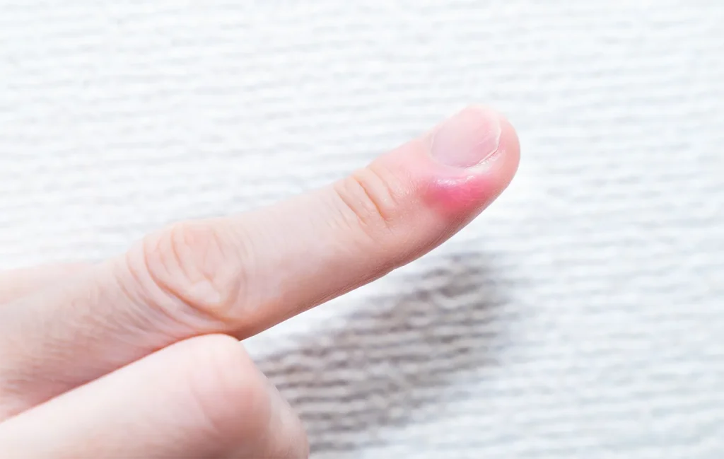 指先にひょう疽の症状が出ている写真