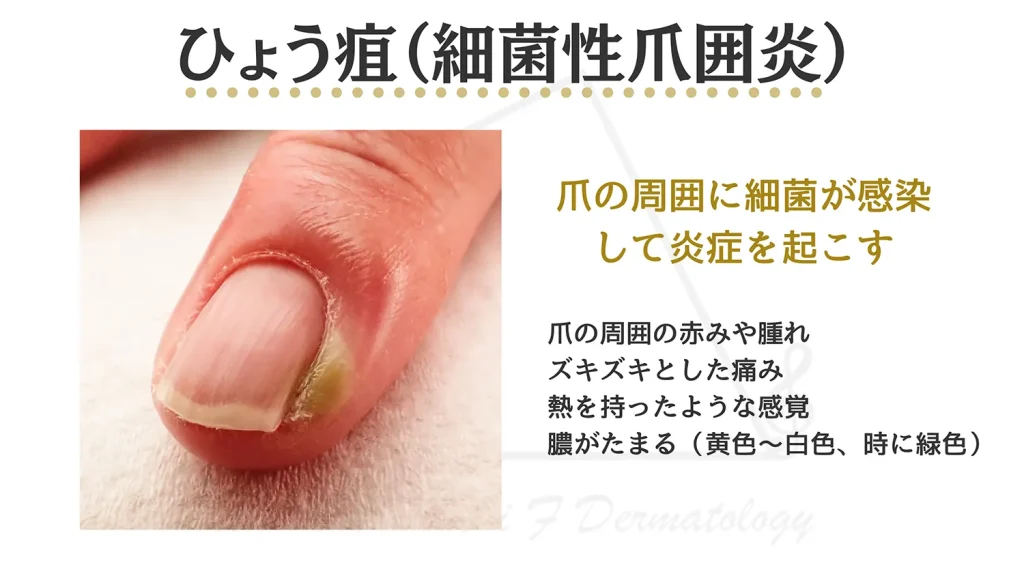 ひょう疽の写真と症状を説明した画像