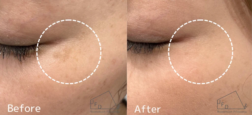 症例  30歳代女性 頬の肝斑 色素沈着