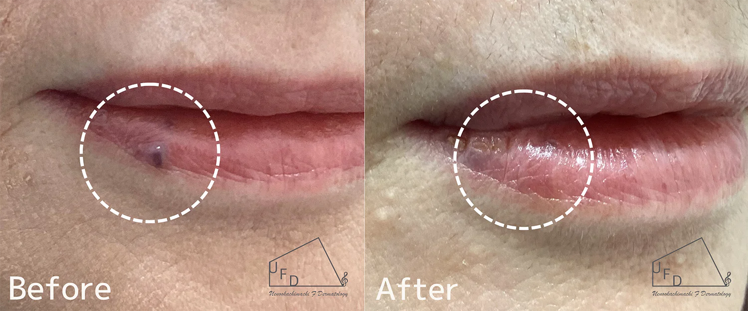 症例2 50歳代女性 口唇の静脈湖　Vビームによる治療