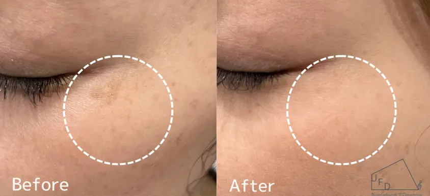 リバースピール症例01