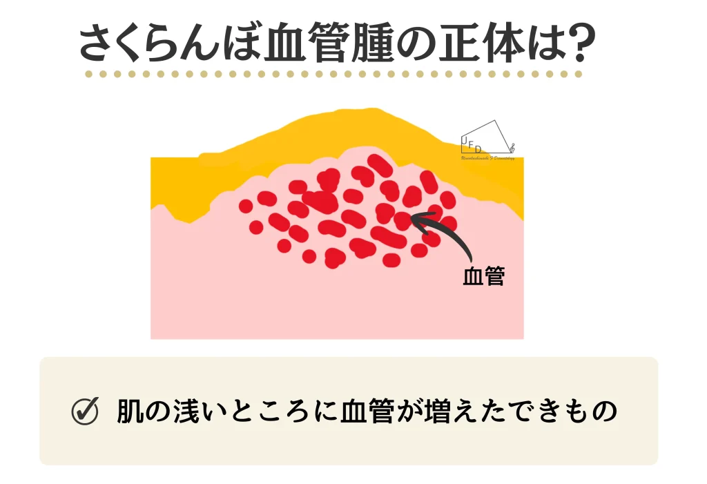 さくらんぼ血管腫の正体とは?