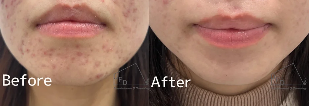 症例1 20歳代女性 顎のニキビ イソトレチノイン 4ヶ月内服