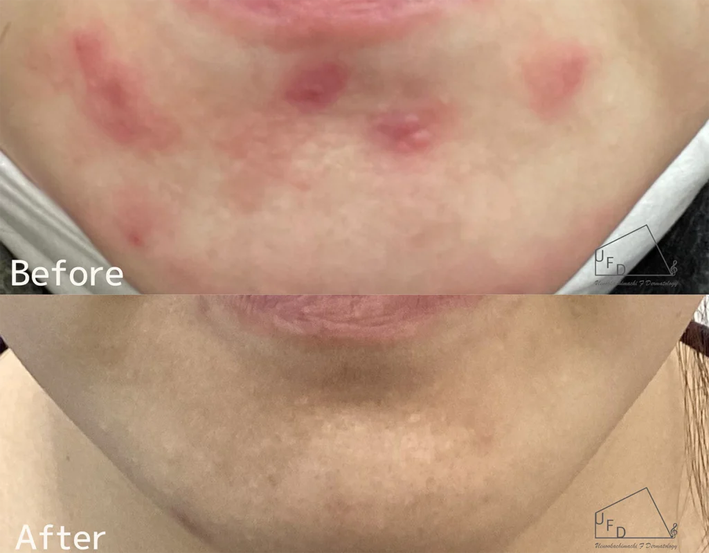 症例3  30歳代女性 口周りのニキビ、ニキビ跡の赤み改善 2回実施