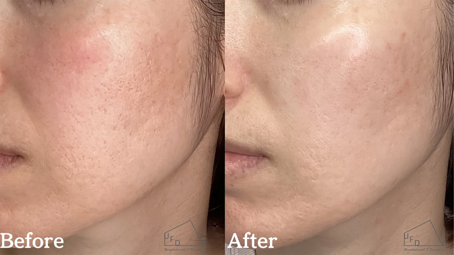 トライフィルプロ症例3