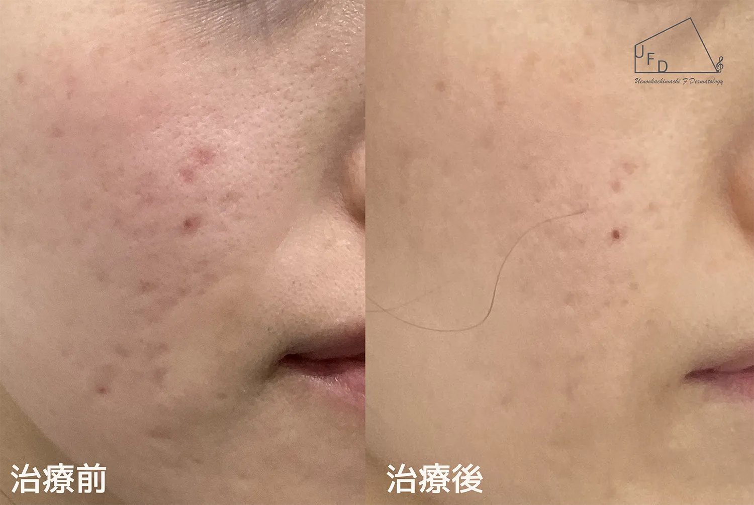 トライフィルプロ症例4 