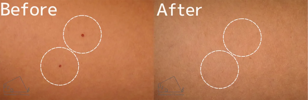 Vビームの症例　30歳代男性 お腹のさくらんぼ血管腫