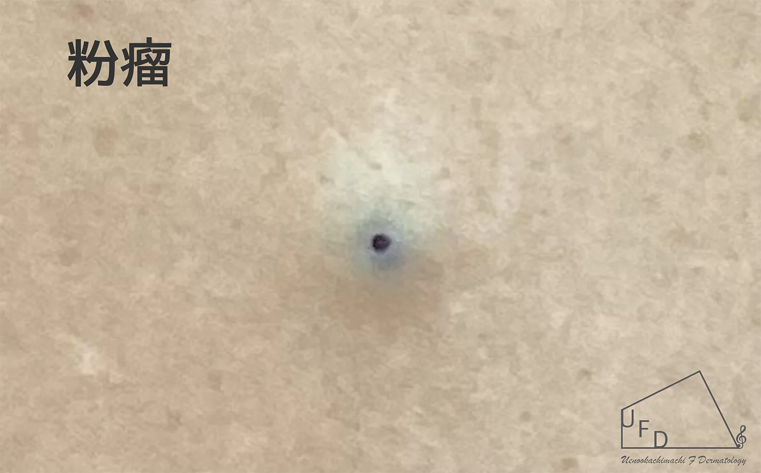 粉瘤の患部写真