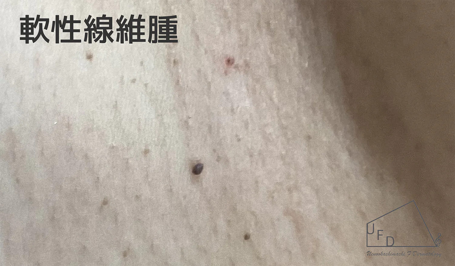 軟性繊維腫の患部写真