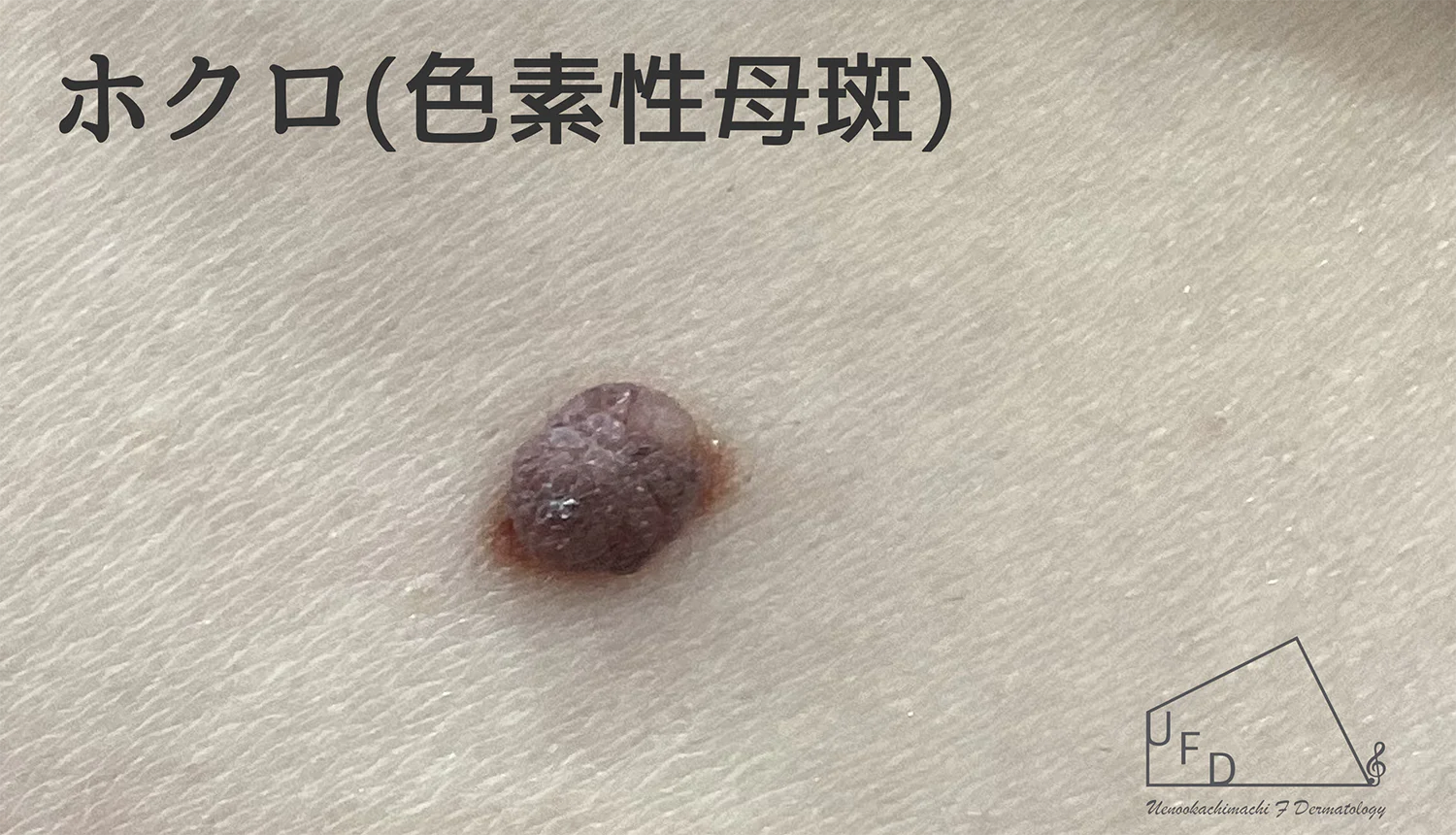 ホクロ 色素性母斑の患部写真