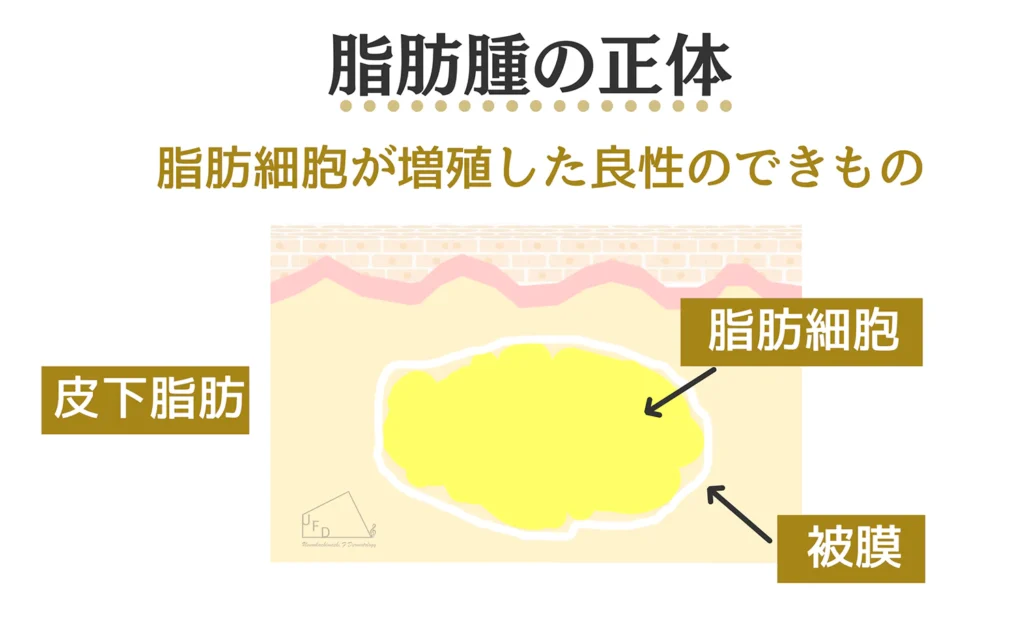 脂肪腫のお肌の状態をイラストで解説