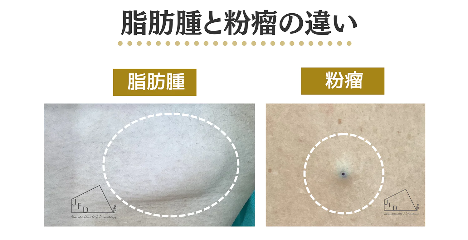 脂肪腫と粉瘤の患部を比較した写真