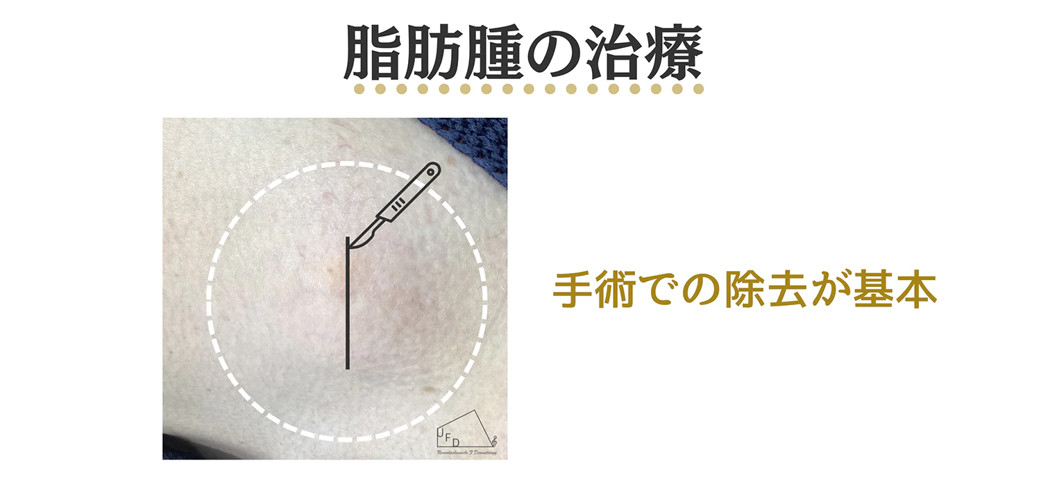 脂肪腫を手術で除去している様子