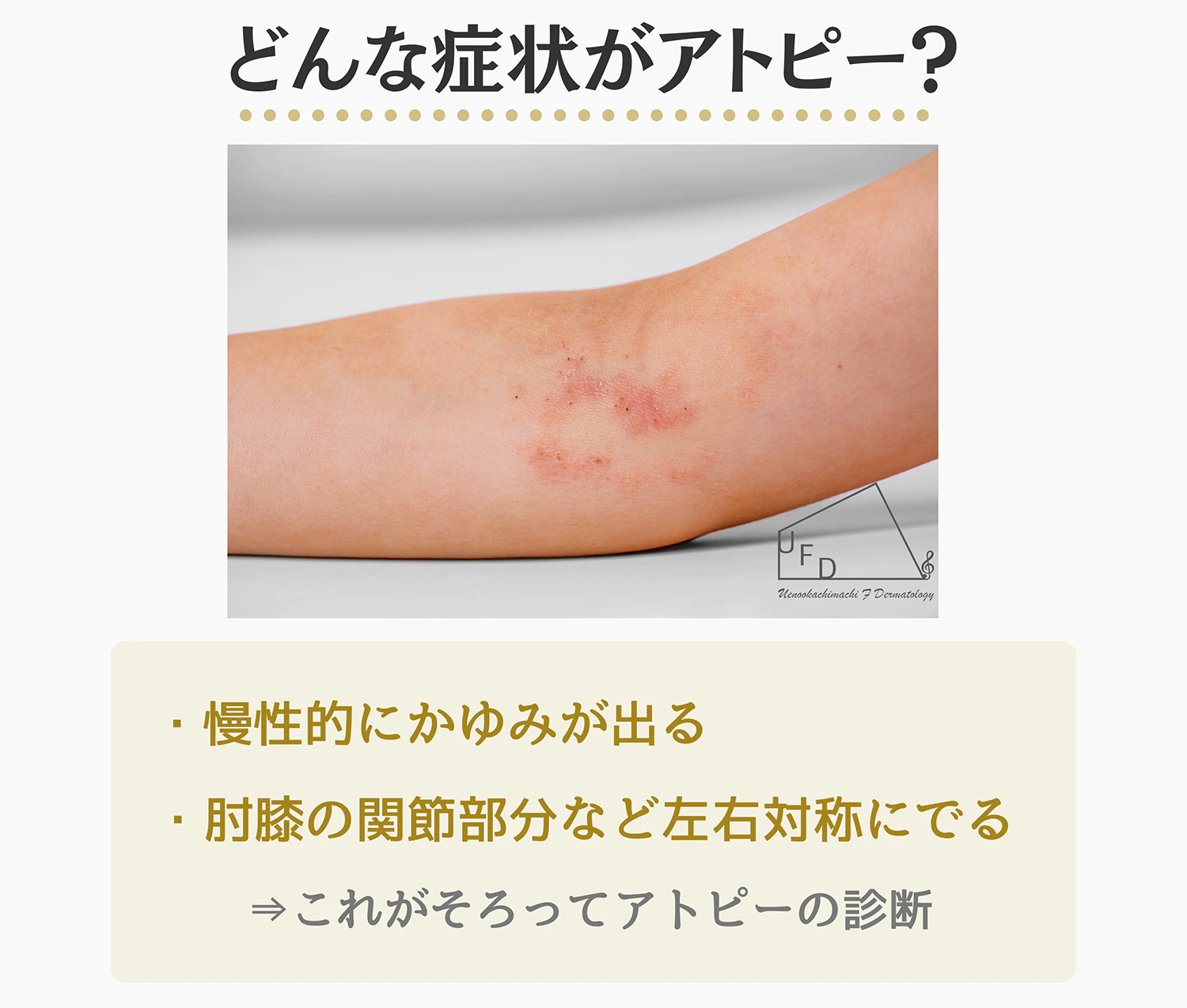 アトピー性皮膚炎の代表的な症状について説明した画像