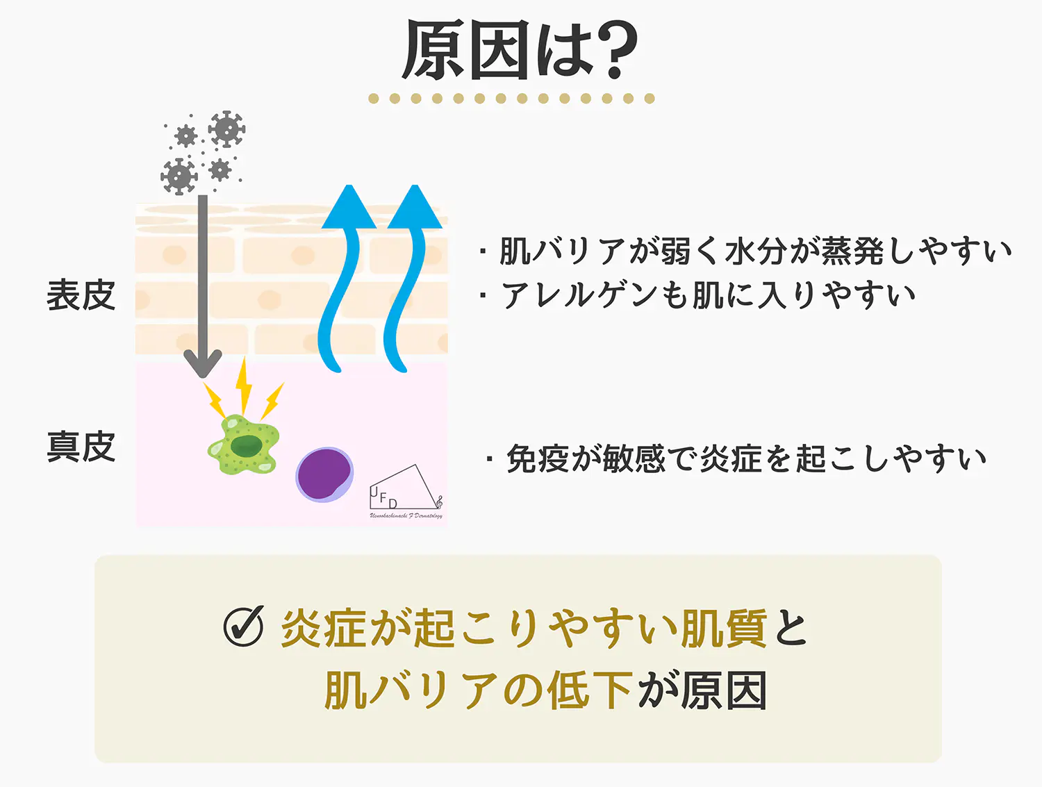 アトピー性皮膚炎の原因について説明した画像