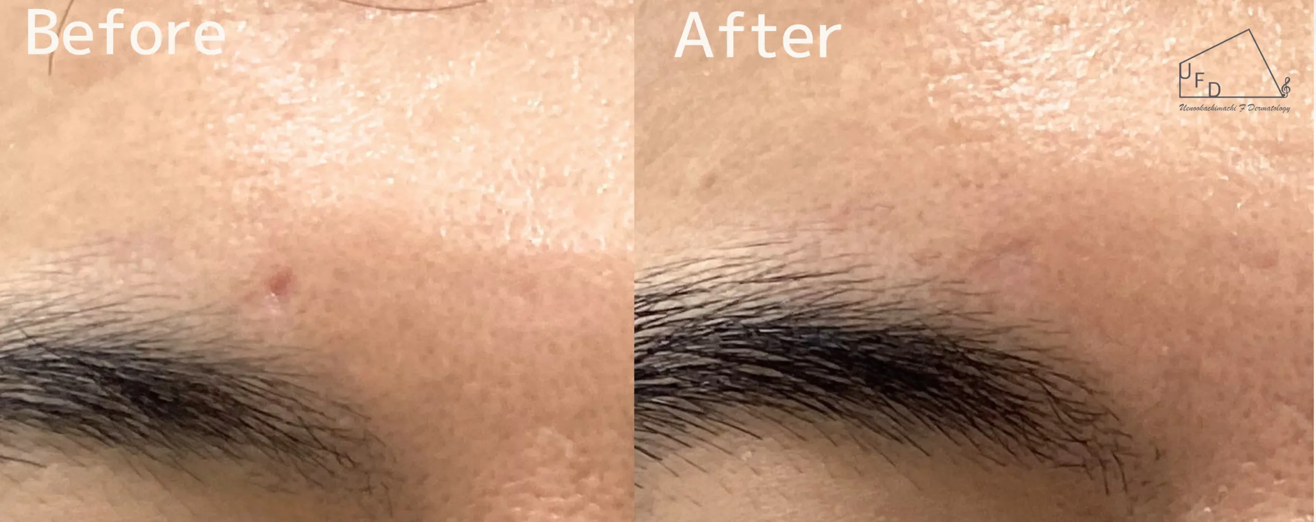 トライフィルプロ症例5