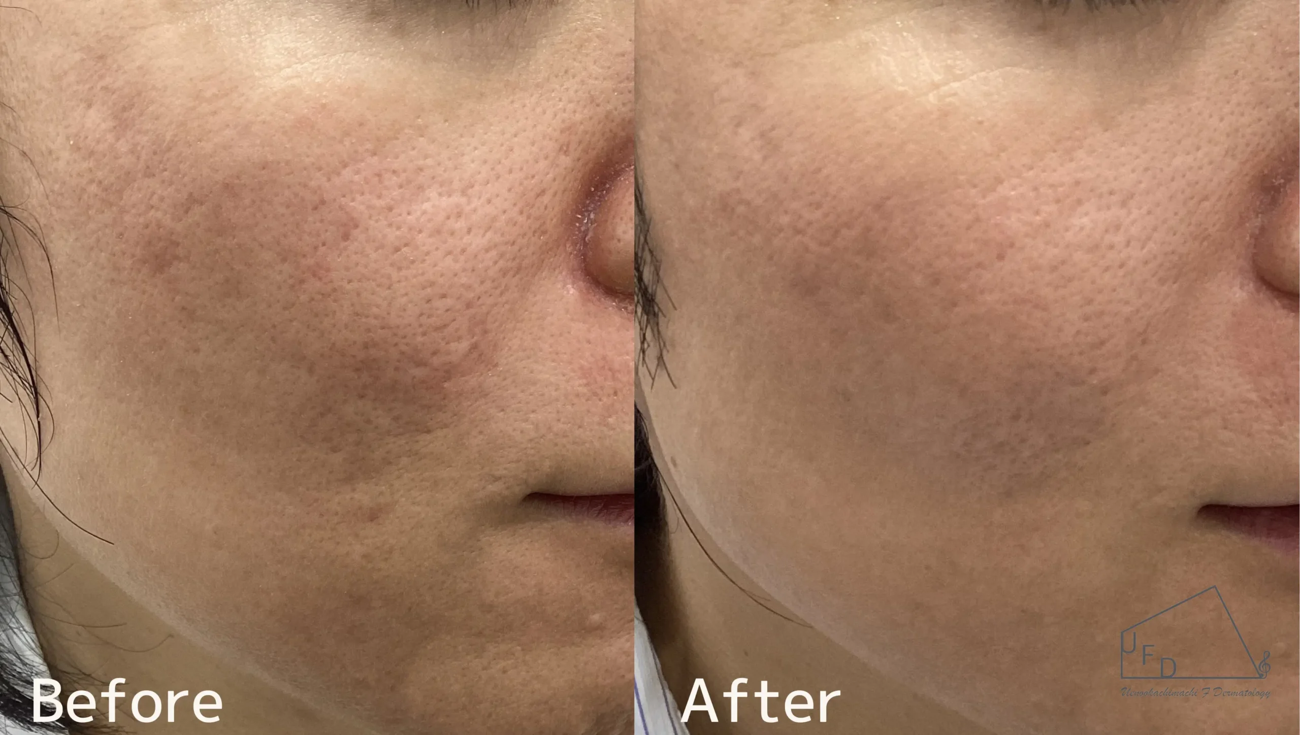 トライフィルプロ症例6