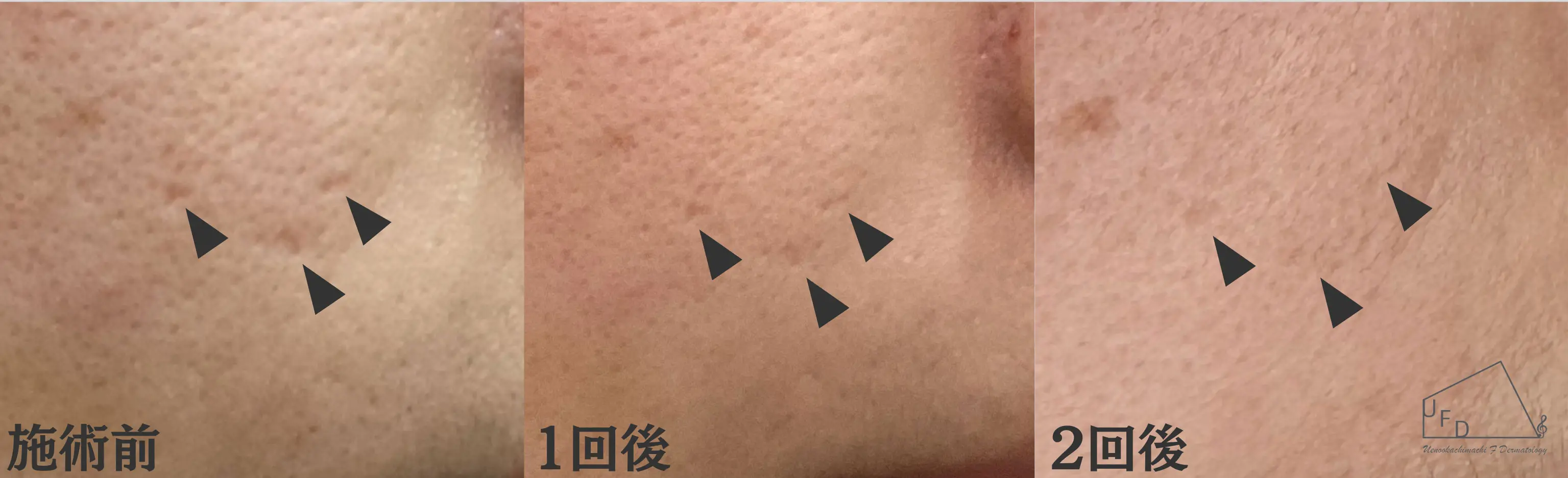 トライフィルプロ症例1