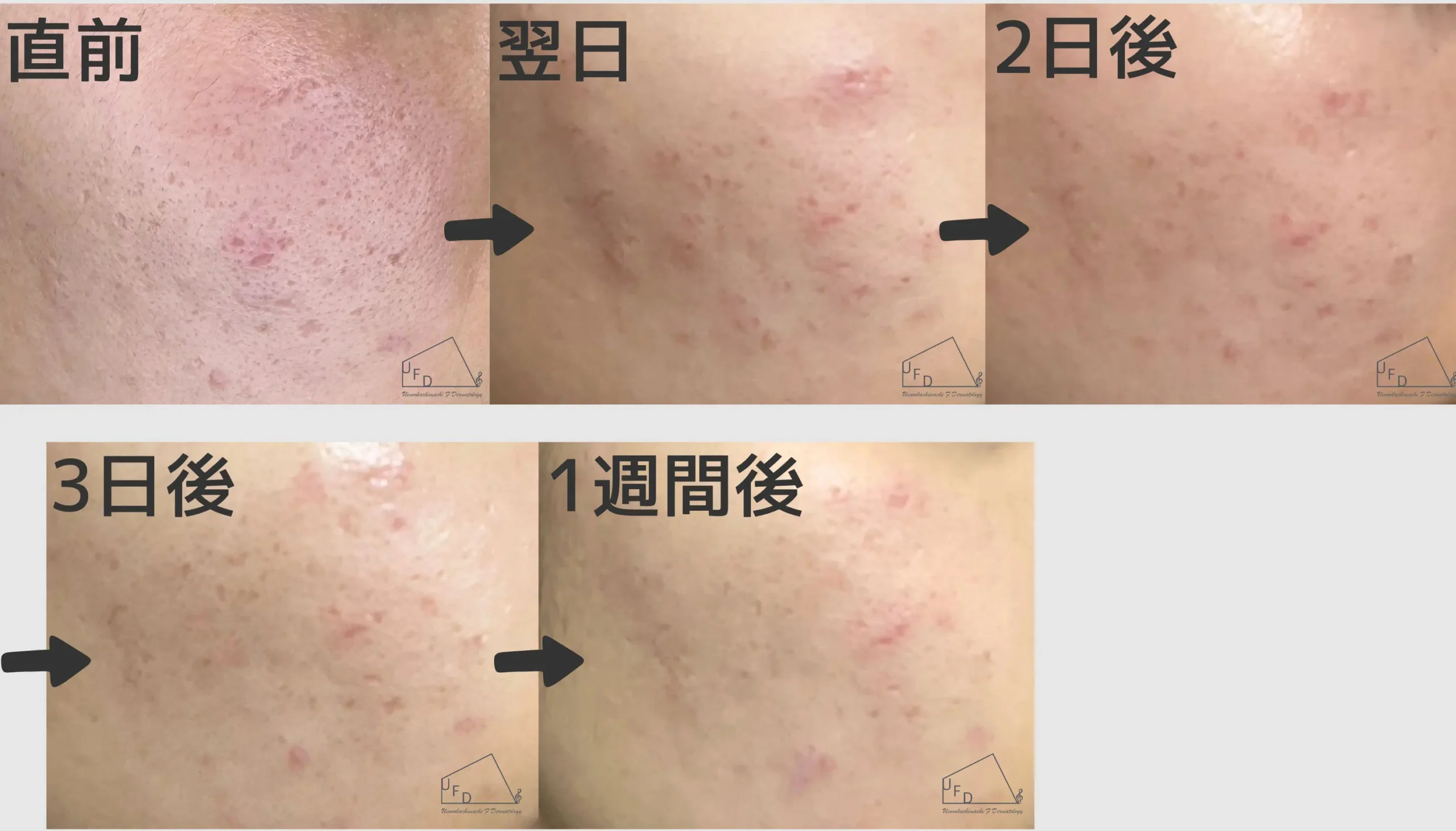 ダウンタイム症例1