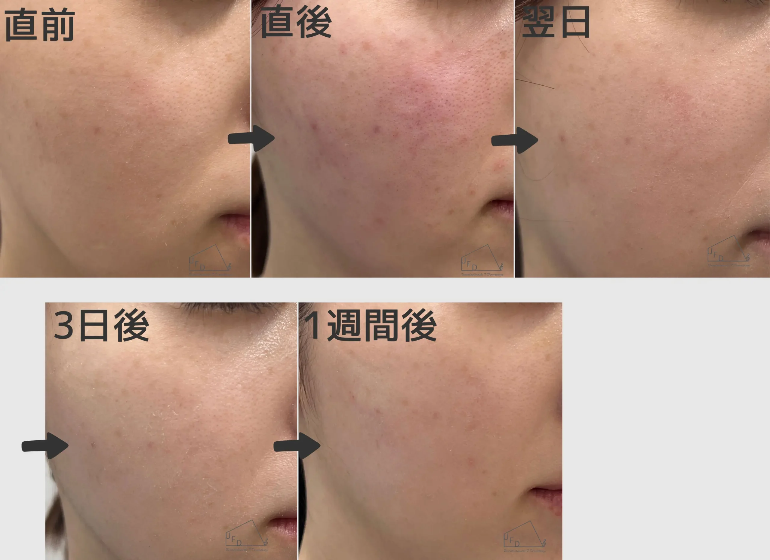 ダウンタイム症例2