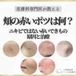 コラム 頬の赤いポツは何？ニキビではない赤いできものの原因と治療 のサムネイル
