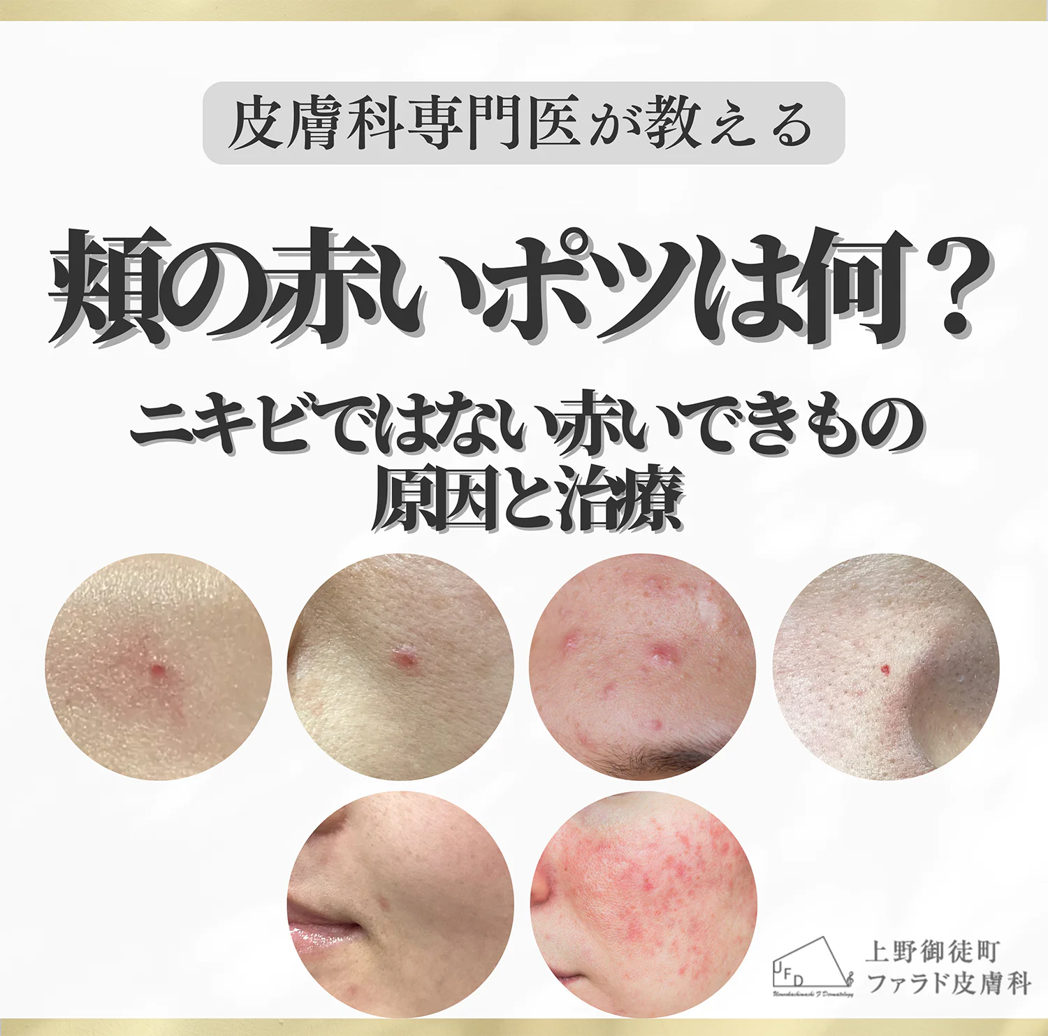 コラム 頬の赤いポツは何？ニキビではない赤いできものの原因と治療 のサムネイル