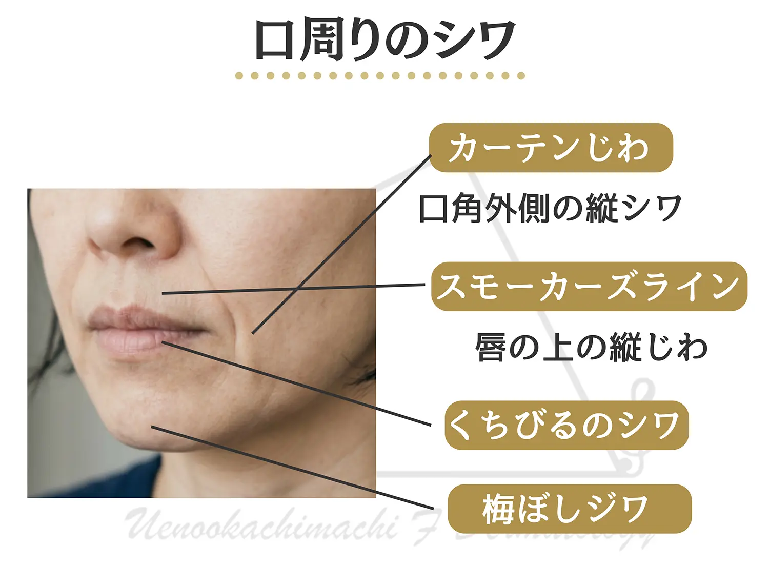 口周りのシワの種類と名称