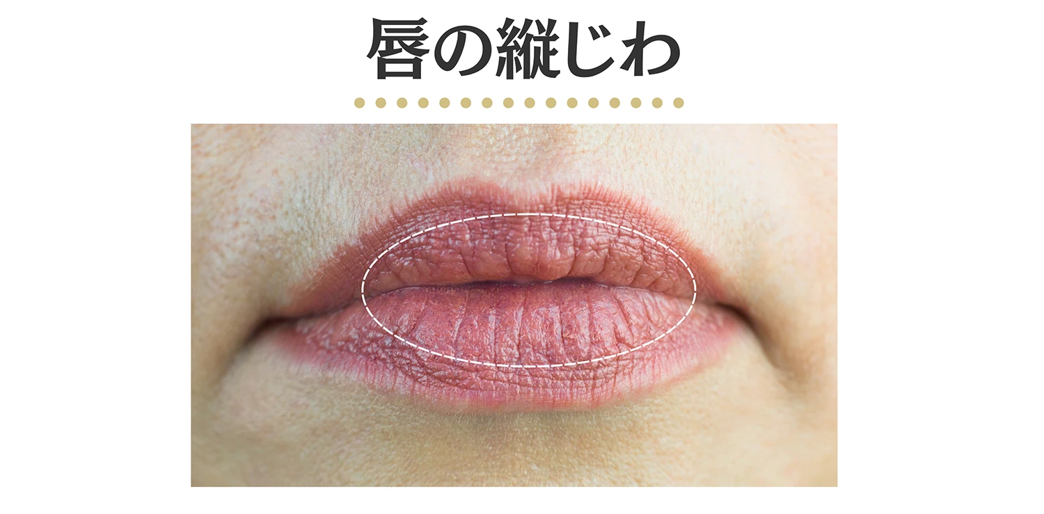 唇そのものの縦ジワの患部写真