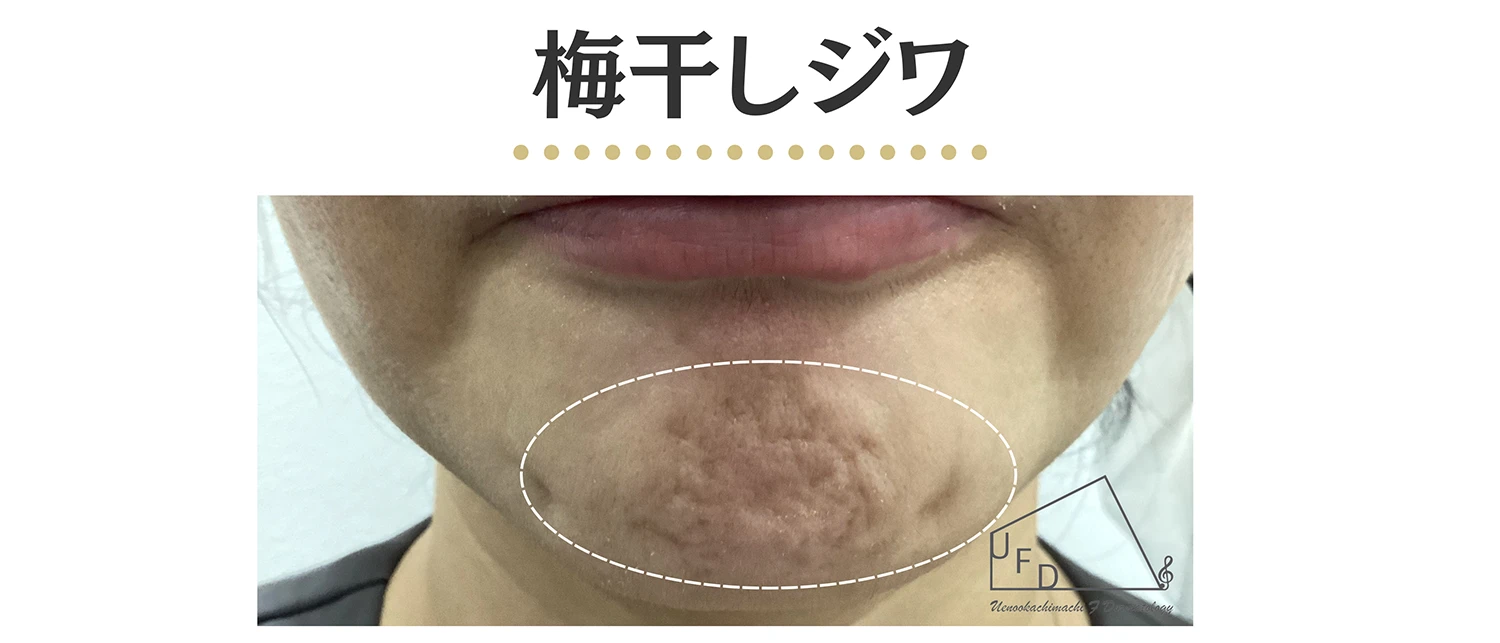 顎のうめぼしジワの患部写真