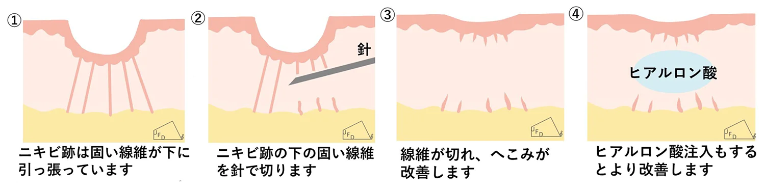サブシジョン施術の図解