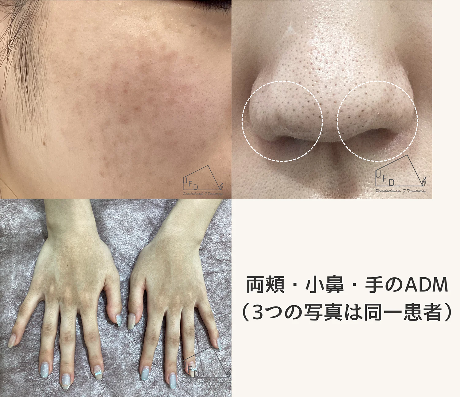 手足に出るADMの患部写真